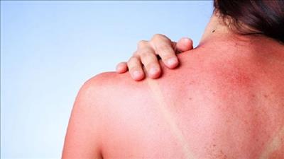 Cẩn trọng với ung thư da do tiếp xúc với ánh nắng mặt trời