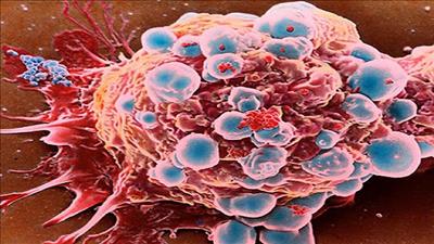 Những dấu hiệu dễ nhận biết của 5 căn bệnh ung thư phổ biến